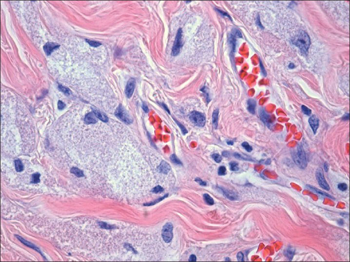 H and E, (×40) histologic section show infiltrative tumor with abundant granular cytoplasm and bland nuclei with small prominent nucleoli