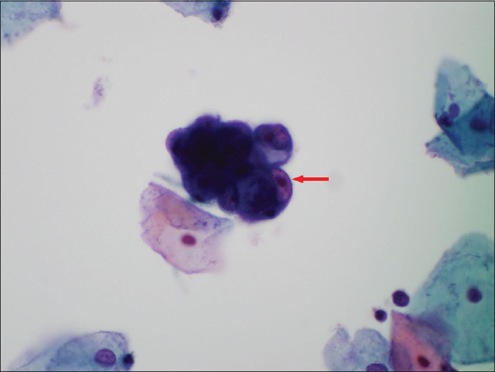 A Papanicolaou cervicovaginal (Pap) test showing atypical endometrial cells (a small group of glandular cells with visible nucleoli-red arrow). The histologic follow-up is atypical complex endometrial hyperplasia. Pap stain, ×600