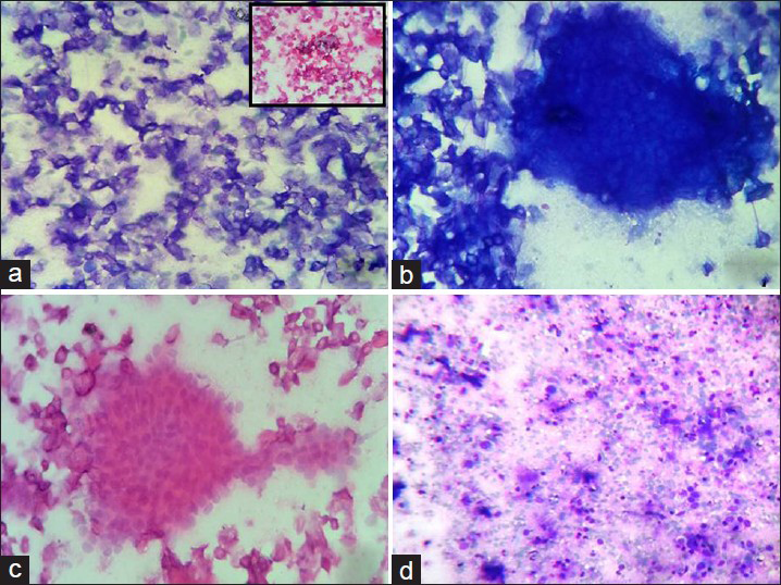 (a) Sheets of anucleated squames (Giemsa, ×400) with foci of calcification (inset H and E, ×400). (b) Island of ghost cells along with anucleated squames (Giemsa, ×400). (c) Cluster of basaloid cells with round to oval nuclei with ill-defined cytoplasm (H and E, ×400). (d) Few anucleated squames with background comprising of inflammatory infiltrate (mainly lymphocytes) few foam cells, few naked nuclei and cellular debris (Giemsa, ×400)