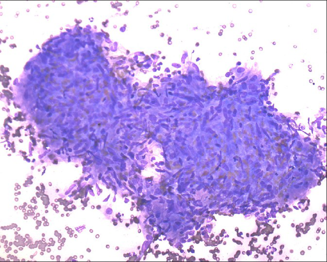 Noncaseating granuloma, smear shows well-defined and compact collection of epithelioid histiocytes with no evidence of necrosis (Diff Quick stain, ×200)