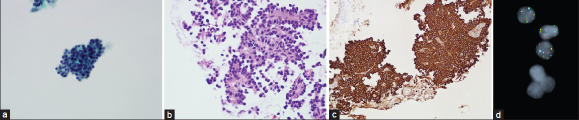 Results of cytologic evaluations. (a) clusters of monotonous cells with a vague rosetting appearance show bland nuclei (Papanicolaou, original magnification × 40). No evidence of ciliated epithelium is present. These cells are difficult to distinguish from bronchial cells because of morphologic similarity. (b) The rosette pattern is more evident on cell block staining (H and E, original magnification × 20). The tumor cells contain more amphophilic cytoplasm than the normal bronchial cells. (c) Strong membranous synaptophysin staining confirms the neuroendocrine origin of the tumor cells (synaptophysin immunohistochemistry, original magnification × 20). (d) Fluorescence in situ hybridization with LAVysion probe set shows 3 copies of the green probe (5p15)