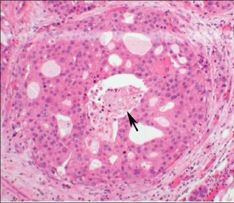 The histologic section of the parotid gland tumor shows a malignant proliferation of a duct, resembling ductal carcinoma in situ of the breast. There is a cribriform architecture with central necrosis (arrow). The cells have prominent nucleoli with apocrine type cytoplasm (H and E, ×10 Obj)