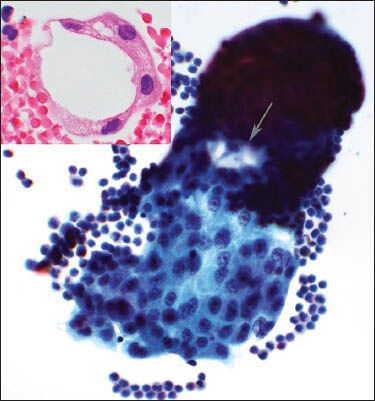 Composite photograph of the pleural fluid shows smears and cell block. The smear shows a single cluster of epithelioid cells with prominent nucleoli and apocrine cytoplasm (Papanicolaou stain, ×40 Obj). A subtle cribriforming feature is noted (arrow). The inset is a photomicrograph of the cell block showing a cluster of malignant epithelioid cells making a lumen (H and E, ×60 Obj)