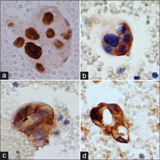 Composite photograph of the immunohistochemical stains performed on the cell block. Panel A is a photomicrograph of androgen receptor showing positive nuclear staining of the malignant cells. Panel B shows human epidermal growth factor receptor-2/neu staining cell membrane of the malignant cells. Panel C illustrates cell membrane and cytoplasmic staining of these cells with MOC-31. Panel D shows cytoplasmic staining of this cluster with gross cystic disease fluid protein-15 (×60 Obj)