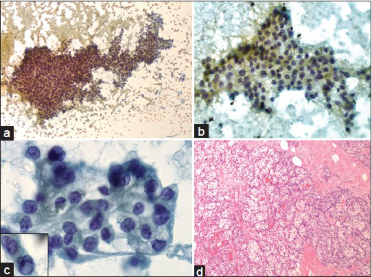 (a) Moderately cellular smear demonstrates three-dimensional clusters of epithelioid to spindled cells in vague papillary configuration with occasional singly dispersed cells (Papanicolaou, ×100). (b) Two-dimensional sheets of epithelioid cells with low nuclear to cytoplasmic ratio (Papanicolaou, ×200). (c) The tumor cells show distinct cytoplasmic borders, clear/vacuolated cytoplasm, regular to convoluted nuclear membranes and inconspicuous nucleoli. Inset shows rare intra-nuclear pseudoinclusion (Papanicolaou, ×400). (d) Histopathologic section of the right breast lumpectomy reveals metastatic low-grade clear cell renal cell carcinoma (H and E, ×100)