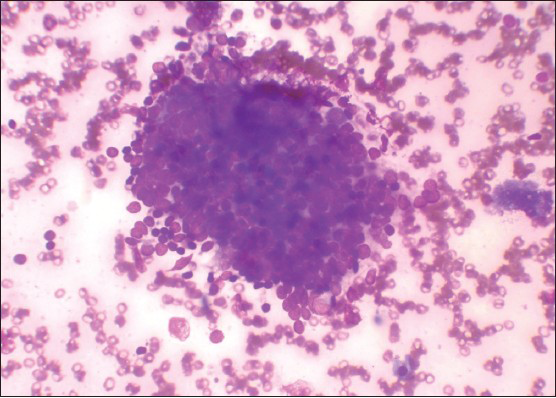 Mild lymphocytic infiltrate in follicular cells cluster and increased background lymphocytes (Leishman's stain, ×400)