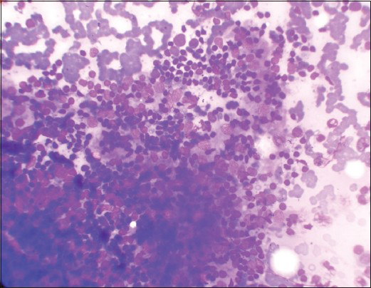 Dense lymphocytic infiltrate in follicular cells cluster (Leishman's stain, ×400)