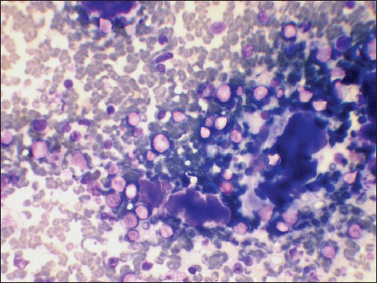 Abundant colloid and lymphoid cells in stages of transformation (Leishman's stain, ×400)