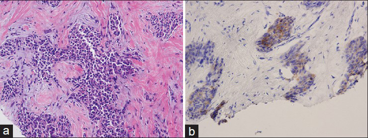 Invasive carcinoma comprised of plasmacytoid tumor cells, is seen on hematoxylin and eosin-stained tissue sections of the core needle biopsy (a). The tumor cells are immunopositive for synaptophysin which supports the diagnosis of neuroendocrine carcinoma (b)