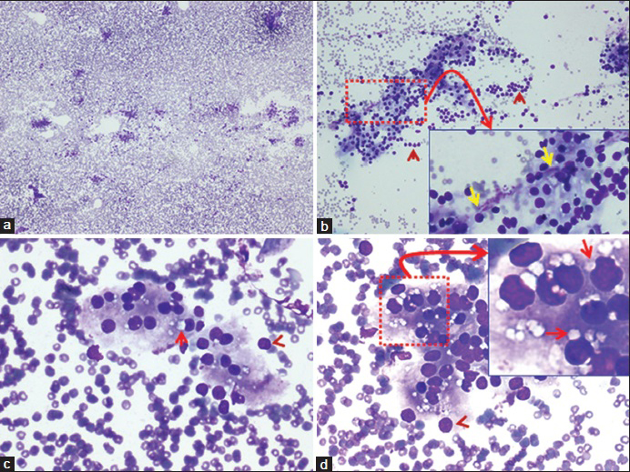 Fine-needle aspiration of neck lesion (Diff-Quik stained preparation). (a) Mildly cellular smear without colloid (×4). (b) Showing small groups of cells forming syncitia, admixed with a few bare nuclei (arrowheads). Inset of “b” (×40 Zoomed) shows occasional fragment of capillary stroma with loosely attached cells (yellow arrows) (×10). (c and d) The cells showed solitary paranuclear intracytoplasmic vacuoles (arrows) without paravacuolar granules. A few bare nuclei are seen at the periphery of the groups (arrowheads). Inset of “d” (×40 Zoomed) highlights the paranuclear intracytoplasmic vacuoles indenting the nuclei (arrows) in many intact cells (×40)