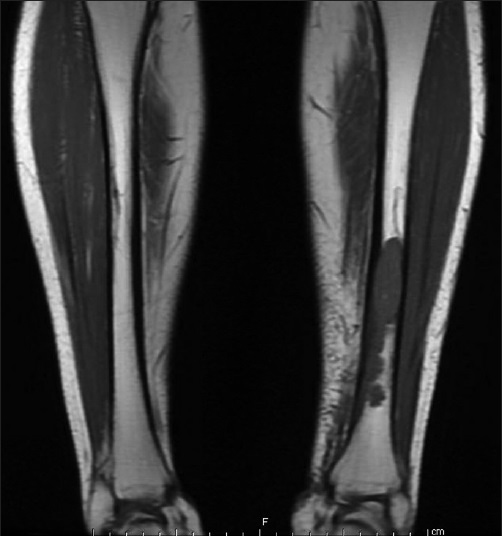 Magnetic resonance imaging of lower extremities demonstrating a left tibial intramedullary lesion with focal extraosseous extension