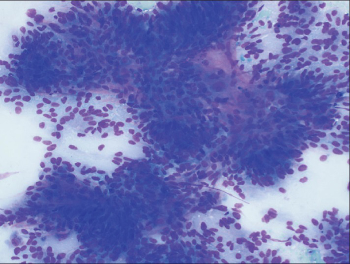 Fine-needle aspiration, left leg, Diff-Quik (×200), showing a cellular yield of cohesive, three-dimensional tumor clusters with cellular overlapping and architectural disorder