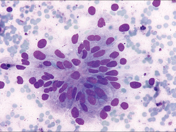 Fine-needle aspiration, left leg, Diff-Quik (×400), columnar tumor cells arranged in glandular configuration with elongated nuclei, mild to moderate nuclear pleomorphism, and finely dispersed chromatin