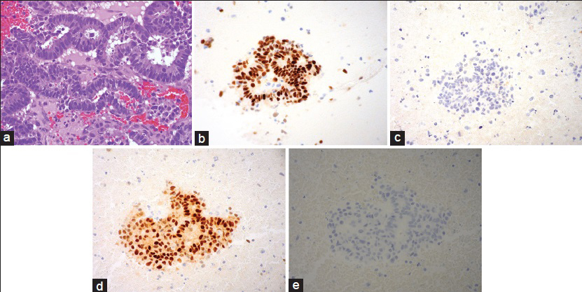 (a) Fine-needle aspiration, left leg, cell block preparation with cribriform tumor glands (H and E, ×400). (b) Estrogen receptor (×400). (c) Thyroid transcription factor-1 (×400). (d) Paired box gene 8 (×400). (e) Mammaglobin (×400)