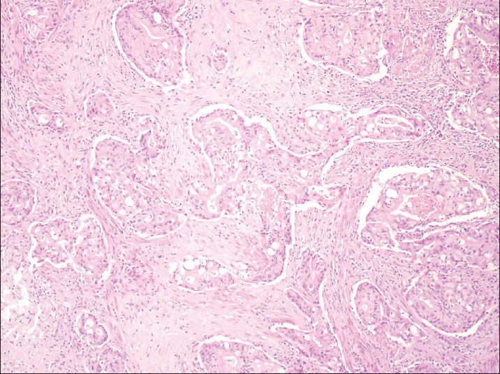 Hysterectomy specimen showing cribriform tumor glands of endometrioid adenocarcinoma infiltrating the myometrium. H and E (×200)