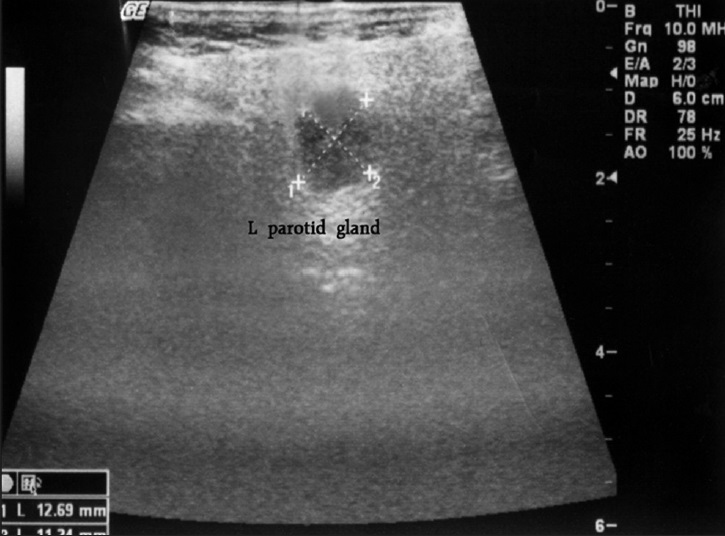 Ultrasonographic picture of the parotid mass