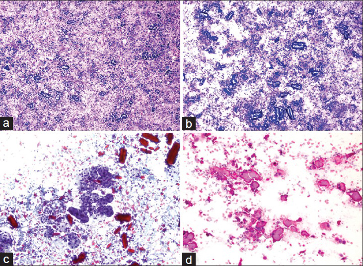 Various cytologic images of the amylase crystalloids on different power and stains. (a) Diff-Quik®, ×100. (b) Diff-Quik®, ×200. (c) Papanicolaou, ×200. (d) H and E, ×400