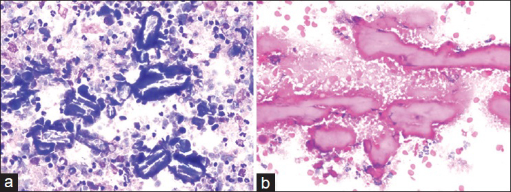 Images of crystalloids at high power magnification with representative morphology. (a) Diff-Quik®, ×400. (b) H and E, ×400