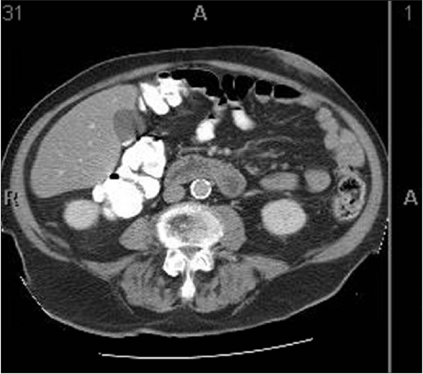 Computed tomography image of abdominal wall lesion. Sections were taken at 5 mm intervals. Image 31 of series #2 shows greatest dimensions of lesion as well as its homogenous nature