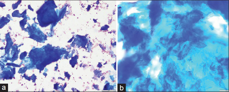 Fine-needle aspiration smears of amyloid, Diff Quik stain. (a) Smear shows abundant deep blue/purple colored amorphous material (×20). (b) On high power, this material resembles has tissue paper appearance, resembling keratin debris (×40)