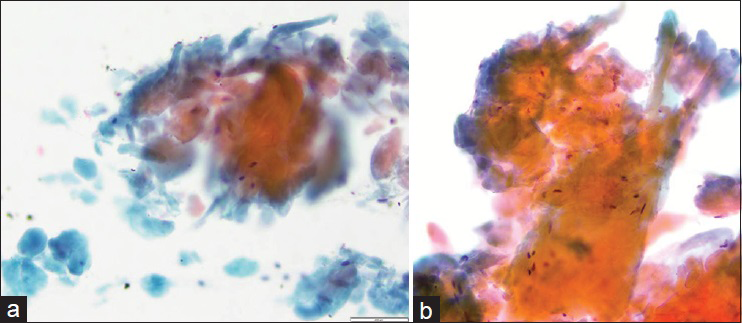 Fine-needle aspiration smears of amyloid, Papanicolaou stain. (a) Orangophilic waxy material is abundant on this smear. Smaller globules in the lower left corner mimic anucleated squamous cells (×20). (b) High power demonstrates dense waxy appearance of amyloid; a few spindled cells are seen intermixed with amyloid (×40)