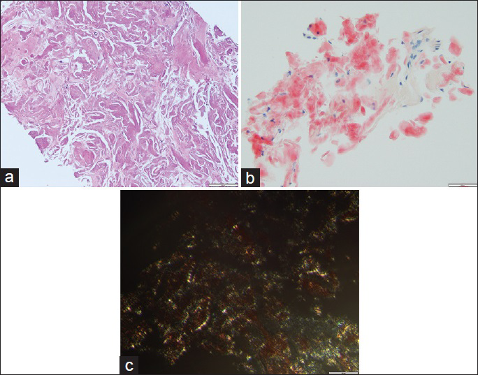 Core biopsy. (a) This core biopsy slide shows amorphous eosinophilic dense material (H and E, ×20). (b) The material is homogeneous and red with Congo stain (Congo, ×20). (c) The core biopsy shows apple green/yellow birefringence (Congo, under polarized light, ×40)