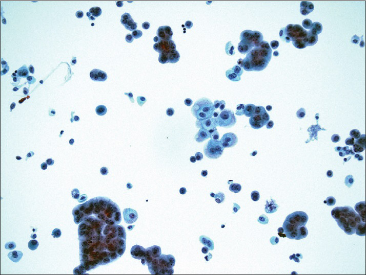 Positive for high-grade urothelial carcinoma. Papillary clusters of malignant urothelial cells show nuclear hyperchromasia, nuclear enlargement, and irregular nuclear membrane (ThinPrep®, Pap stain ×40)