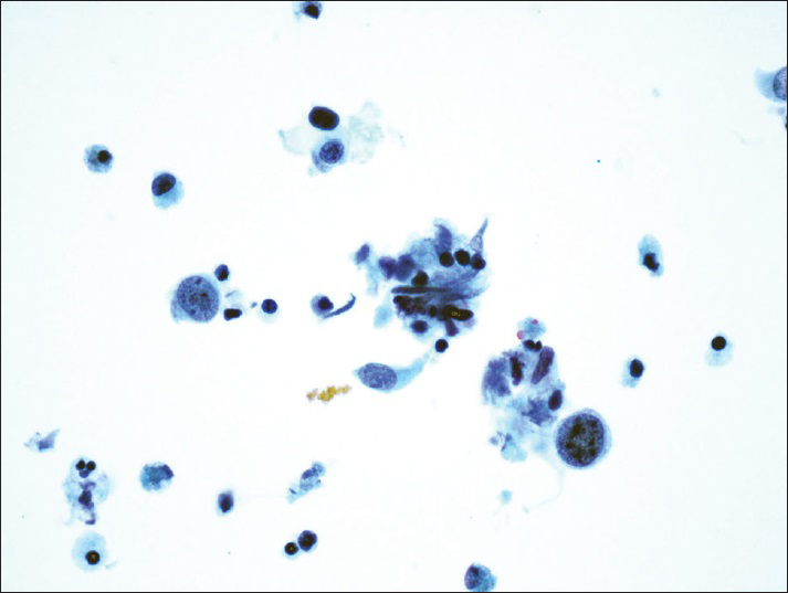 Atypical urothelial cells, cannot exclude high-grade urothelial carcinoma. Rare atypical urothelial cells with cytomorphologic features suggestive of high-grade urothelial carcinoma (ThinPrep®, Pap stain ×40)