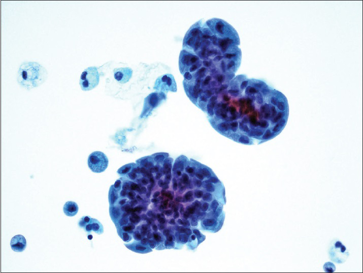 Low-grade papillary urothelial carcinoma. Tight clusters of hyperchromatic urothelial cells show nuclear membrane irregularity. The cells lack nuclear pleomorphism. The concurrent histology revealed low-grade papillary urothelial carcinoma (ThinPrep®, Pap stain ×40)