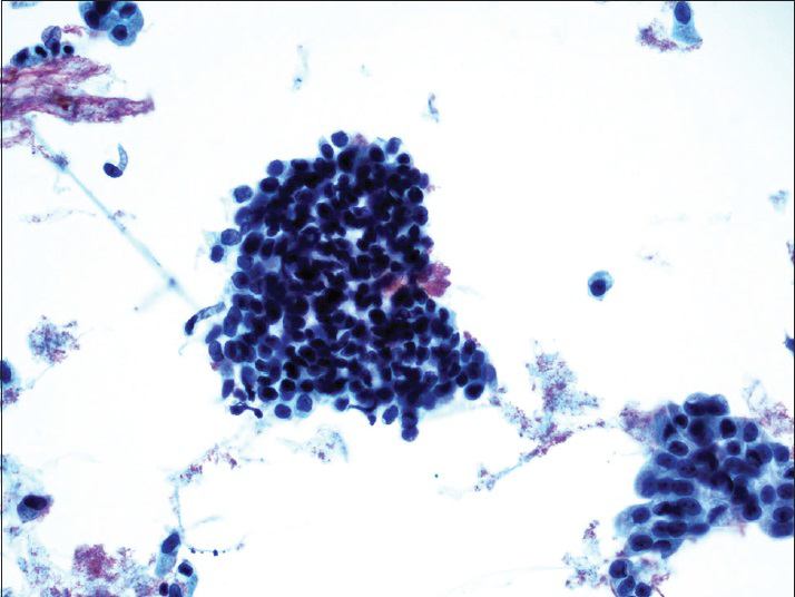 Benign urothelial cells from the upper tract show tight pseudopapillary clusters, typically due to instrumentation. The urothelial cells have relatively low N/C ratio, no nuclear membrane irregularity, and no nuclear hyperchromasia (ThinPrep®, Pap stain ×20)