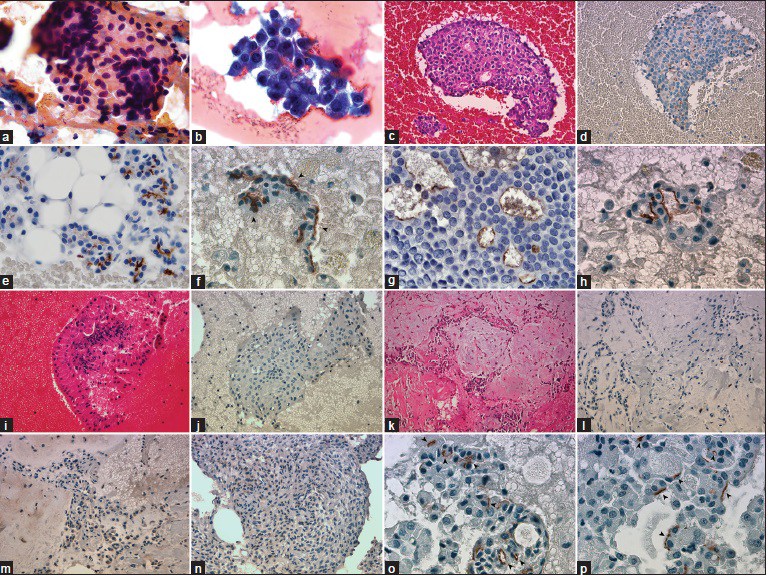 (a) Large granular cytoplasm with round eccentrically located nuclei (PAP, ×1000). (b) Clusters are composed of malignant acinar cells, thin-granular large cytoplasm, and mildly atypical nuclei (Diff-Quik, ×1000). (c) Cell block of acinic cell carcinoma (H and E, ×400). (d) DOG1-K9 clone shows diffuse apical-luminal expression in acinic cell carcinoma (Immunohistochemistry, ×400). (e) Apical-luminal staining (2+) in normal serous acinar cells (Immunohistochemistry, ×1000). (f-h) Apical-luminal staining in acinic cell carcinomas, (1+, 2+, 3+), respectively, (Immunohistochemistry, ×1000). (i) Warthin Tumor is easily recognized with mature lymphocytes wrapping oncocytic cells (H and E, ×400). (k-m) Cell block of pleomorphic adenoma, areas of focal weak cytoplasmic granular positivity, and negativity in the identical case (H and E and Immunohistochemistry, ×400). (n) Focal, weak cytoplasmic granular staining in myoepithelioma case (Immunohistochemistry, ×400). (o and p) Apical-luminal staining (subcellular localization) in acinic cell carcinomas, (Immunohistochemistry, ×1000)