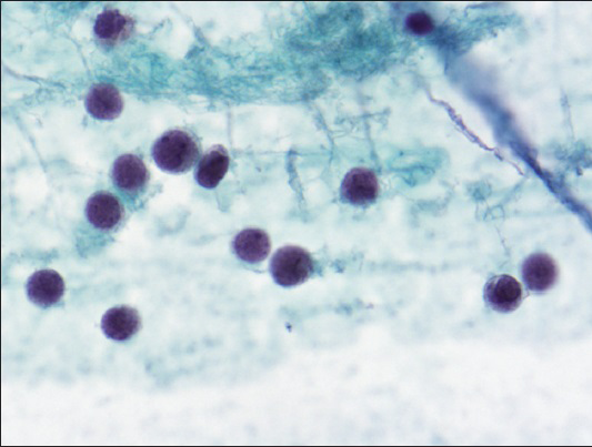 Loosely dispersed malignant cells with round to oval nuclei, irregular nuclear borders, stippled chromatin pattern, inconspicuous nucleoli, and scant cytoplasm (Papanicolaou, ×600)