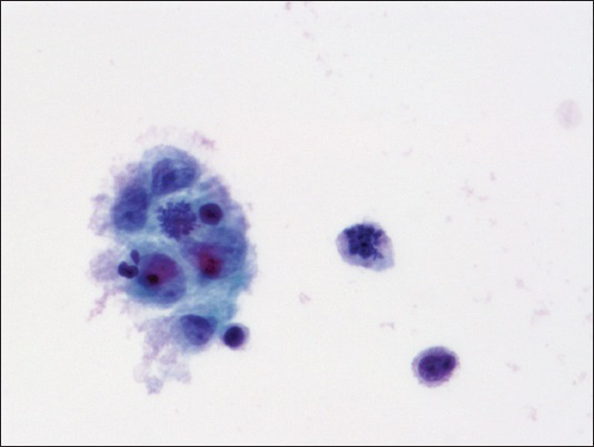 Malignant cells arranged in clusters with occasional mitotic figures (Papanicolaou, ×600)