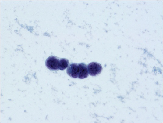 Malignant cells arranged in single-file pattern with focal nuclear molding (Papanicolaou stain, ×600)