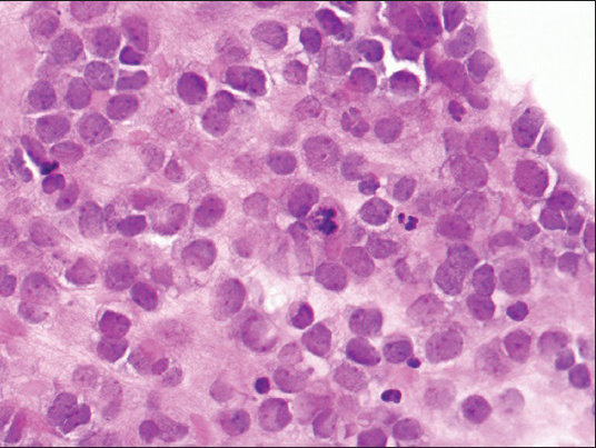 Cell block showing loosely dispersed malignant cells with high nucleus to cytoplasmic ratio, fine to clumped chromatin pattern, occasional small inconspicuous nucleoli, irregular nuclear borders, and scant eosinophilic cytoplasm (H and E, ×400)