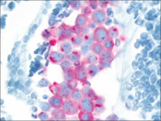 Tumor cells with “dot-like” rim pattern of staining with CK20 (×400)