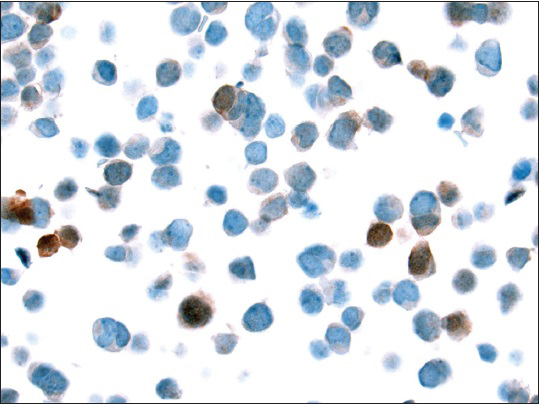 Few tumor cells showing nuclear staining with Merkel cell polyomavirus monoclonal antibody (CM2B4) (×400)