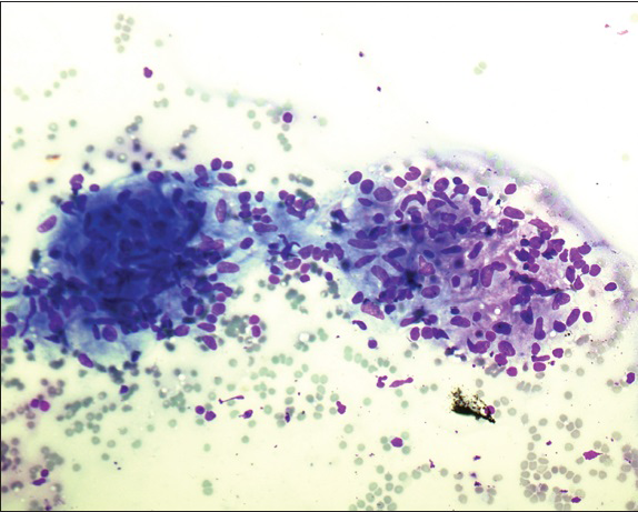 Non caseating granuloma, smear shows two well-defined collection of epithelioid histiocytes with no frank evidence of necrosis (Diff Quick stain, original magnification ×200)