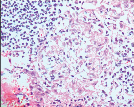 Granuloma, high power view, cell block, localized collection of epithelioid histiocytes surrounded by a rim of lymphocytes (H and E, original magnification ×500)