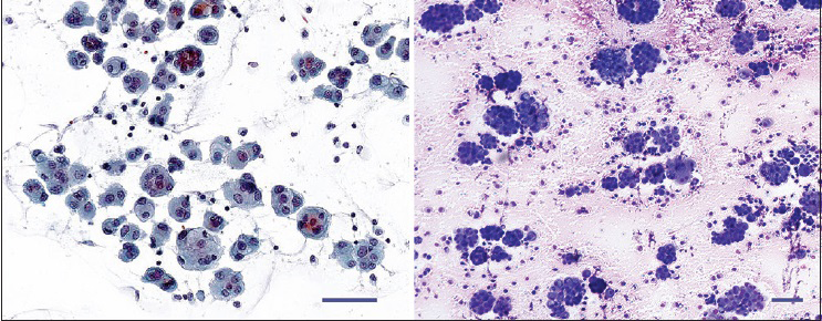 Effusions with epithelioid mesothelioma. The specimen is often highly cellular, containing large and small tissue fragments (left Papanicolaou PAP, right May-Grünewald-Giemsa; bar = 50 μm). Photo: VA left frame; AH right frame