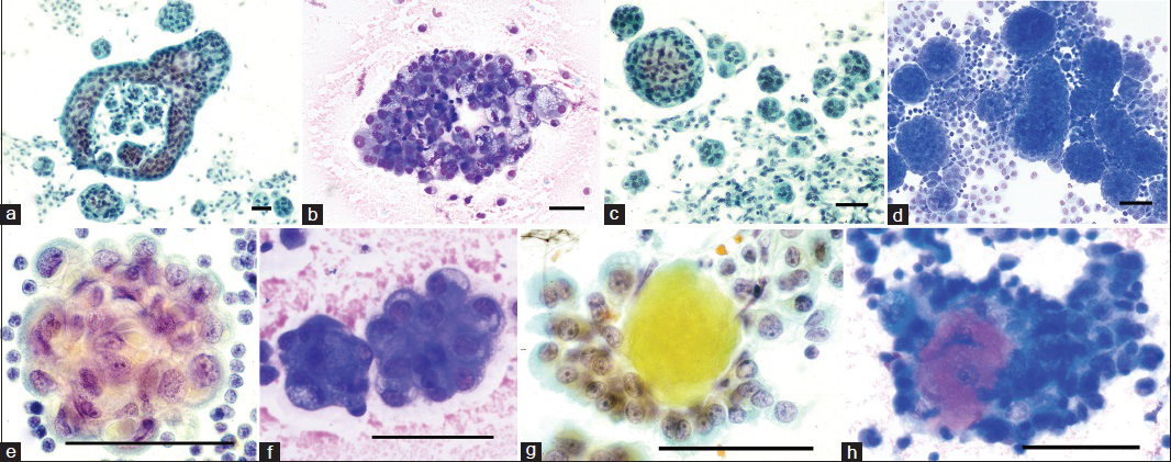 Cytomorphology of epithelioid mesothelioma cells and tissue fragments in effusions. The tissue fragments sometimes show gaps or windows, (a and b) occur both as spheres with smooth surfaces (c and d) and in berry-like clusters with scalloped surface (e and f). The tissue fragments may contain acidophilic extracellular matrix cores also known as collagen or basement membrane cores (g and h) which with May-Grünewald-Giemsa (MGG) becomes strongly acidophilic, similar to the extracellular granular material that can be seen in the background [Figures 1 and 2f], indicating large amounts of hyaluronan (left PAP stain, right MGG stain; bar = 50 μm). Photo: VA frames a, c, e and g; AH frames b, d, f and h