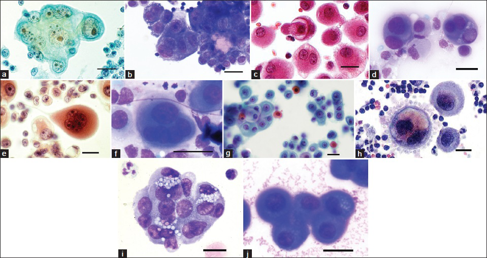 Cytomorphology of the epithelioid mesothelioma cells in effusions. The malignant mesothelioma cells often show macronucleoli. (a and b) There are prominent degree of cell-within-cell arrangements (c and d) and the tumor cells are sometimes multinucleated. (e and f) Some cells may be squamoid with eosinophilic or orangophilic cytoplasm and pyknotic nuclei (g), while others show rounded protrusions or “blebbing” from the cell membrane. (h) The tumor cells may develop cytoplasmic vacuoles which punch holes in the nucleus in May-Grünewald-Giemsa (MGG)-stained slides, (i) as well as a reddish haze at the periphery of the cells, (j) corresponding to the location of hyaluronan synthesis. (a, c, e and f PAP stain; b, d, f, h, i, j MGG stain; bar = 25 μm). Photo: VA frames a, c, e, h and i; PF frame g; AH frames b, d, f and j