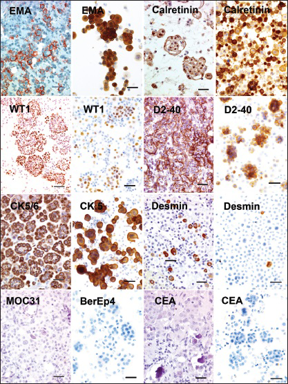 Immunohistochemical and immunocytochemical reactivities of malignant mesothelioma (MM) cells as seen in cell blocks (first and third column) and cytospin preparations (second and fourth column). Epithelial membrane antigen and D2-40 positivity is accentuated at the cell membrane, while specific WT1 reactivity is nuclear. The effusion with MM cells often also contains scattered benign mesothelial cells that contain desmin reactivity (bar = 50 μm). Photo CWM columns 1 and 3, AH columns 2 and 4