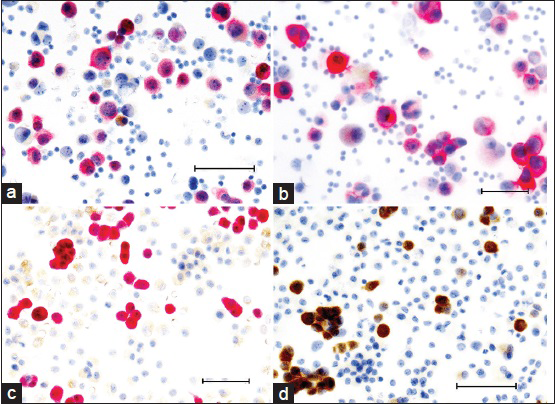 The use of double stainings. Cytospin preparations double-stained for BerEp4 (brown) and calretinin (red; left column) and desmin (brown) and epithelial membrane antigen (red; right column) are useful to distinguish malignant mesothelioma (MM) from both adenocarcinomas and reactive mesothelial cell proliferations. In MM samples the tumour cells show dominant reactivity to Calretinin and epithelial membrane antigen (a and b), while reactive benign mesothelial cells reacts to calretinin and desmin (c and d). Bar = 100 μm. Foto: AH