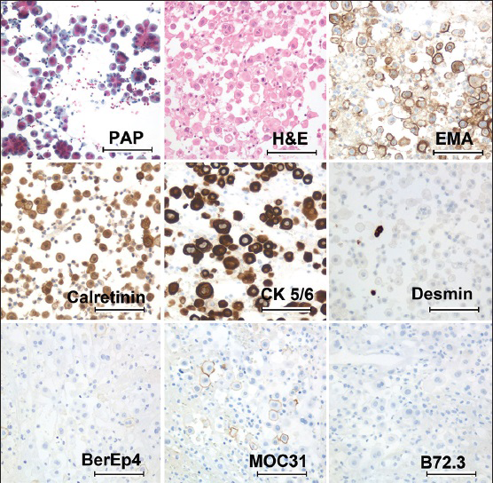 Diagnostic markers used in the differential diagnosis between diffuse malignant peritoneal mesothelioma (DMPM) and serous carcinoma. A large number of tumor cells is seen in PAP-stained slides and a H and E-stained section from a cell block from a DMPM effusion. DMPM expresses epithelial membrane antigen, calretinin and cytokeratin 5/6, and unlike reactive mesothelial cells, it only has focal Desmin expression. Ber-EP4 and MOC-31 stain few cells, whereas B72.3 stain is negative (bar = 50 μm) Foto: BD