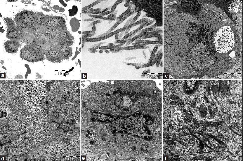 Electron microscopy of malignant mesothelioma (MM) in effusions. The nuclear pleomorphism is normally more extensive than seen in cytomorphology: (a and b) Typically, the apical surface of MM cells is covered by long, slender microvilli, completely devoid of any glycocalyx, and malignancy is shown by the finding of neolumina, that is, apical cell membranes with microvilli as either a + cytoplasmic vacuole (c) or in-between cells with connecting desmosomes, replacing the basolateral membrane. (d) Cytoplasmic filaments are often seen surrounding the nucleus as a “scarf”, (e) sometimes forming coarser tonofibril structures [f; also cf. Figure 3 g]