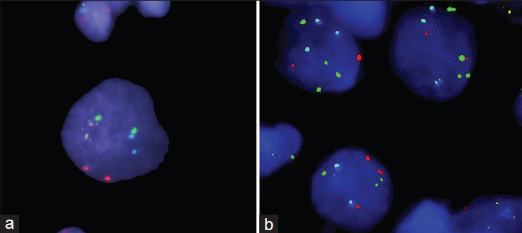 Fluorescent in situ hybridization analysis of ploidy. The Abbot Urovysion® kit labels centromeric sequences on chromosomes 3 (red), 7 (green) and 17 (blue), showing gains or losses of the chromosome, while the fourth probe (yellow) labels the 9p21 band, containing the p16INK gene. The benign cell (a) shows two signals for each probe while the malignant mesothelioma cells often present with homozygous deletion of the 9p21 band (b)