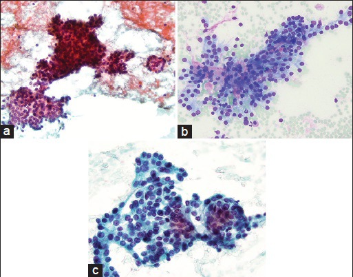 (a) Cellular smear showing large branching and smaller acinar-like structures (Papanicolaou stain, ×20). (b) Branching architecture with magenta colored mucoid material surrounded by bland appearing cells with delicate cytoplasm (Diff Quik stain, ×20). (c) On this high power magnification, cells are uniform with nuclei that are round to ovoid in shape and small visible nucleoli. No necrosis or mitosis seen (Papanicolaou stain, ×40)