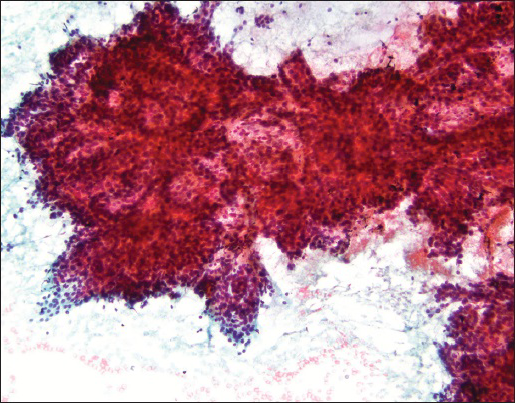 A very large complex branching sheet with no visible fiborvascular cores (Papanicolaou stain, ×10)