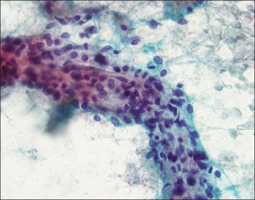 A mixture of round, ovoid, and spindled cells are seen (Papanicolaou stain, ×40)